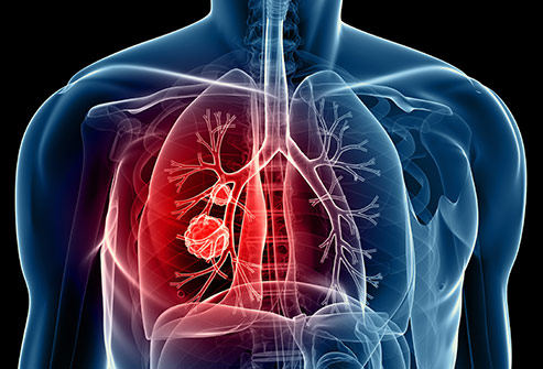 Cảnh báo bệnh ung thư phổi, ung thư vòm họng đến từ thuốc lá