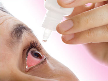 Lạm dụng corticoid khi đau mắt đỏ có thể dẫn đến thủng giác mạc