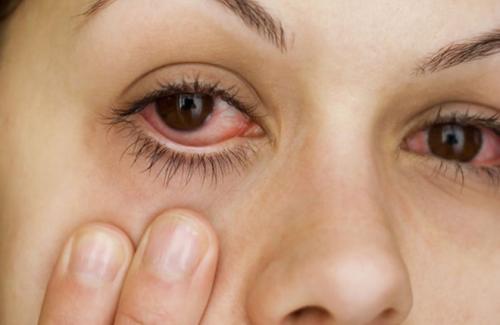 Cảnh báo những dấu hiệu nhận biết căn bệnh đau mắt đỏ