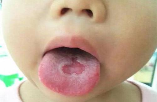 Nhiệt miệng ở trẻ dưới 1 tuổi - triệu chứng, nguyên nhân và điều trị bệnh