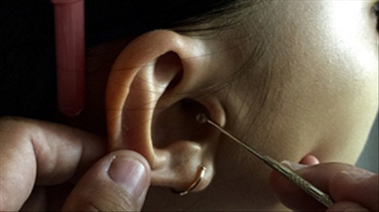 Nguy cơ thủng màng nhĩ ở trẻ do lấy ráy tai không đúng cách