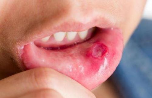 Triệu chứng bệnh nhiệt miệng được nhận diện như thế nào?