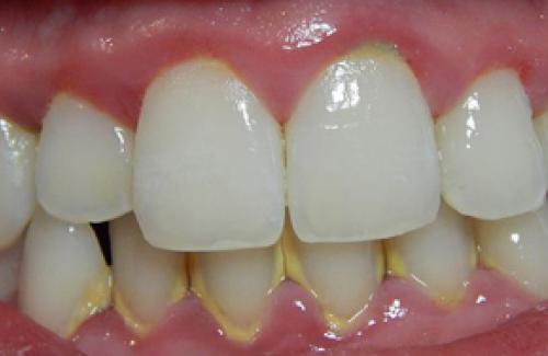 Vôi răng là gì? Tác hại của vôi răng ảnh hưởng đến răng như thế nào?