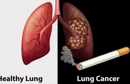 Hút thuốc lá - Nguy cơ gia tăng ung thư phổi càng cao