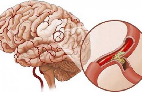 Chẩn đoán và xử trí căn bệnh tai biến mạch máu não