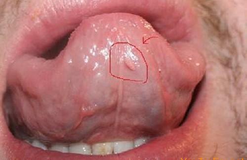 Sùi mào gà ở lưỡi là gì? Bệnh gây nguy hiểm như thế nào?