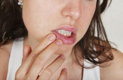 Sùi mào gà ở miệng - nguyên nhân, triệu chứng và cách điều trị bệnh
