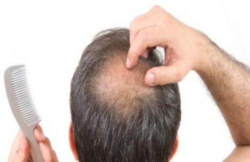 Rụng tóc ở nam giới - nguyên nhân và phương pháp xử lý
