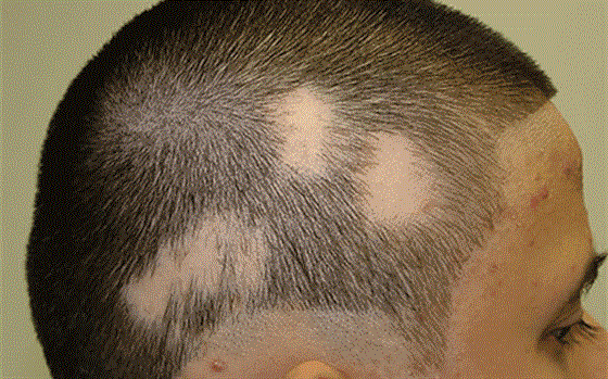 Rụng tóc ở nam - nguyên nhân và cách điều trị hiệu quả