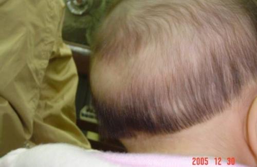 Rụng tóc ở trẻ sơ sinh - dấu hiệu, nguyên nhân và hướng điều trị