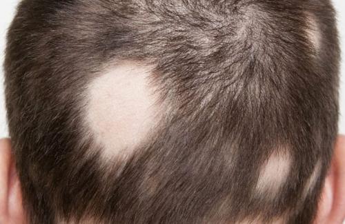Rụng tóc từng mảng - triệu chứng, nguyên nhân và cách điều trị