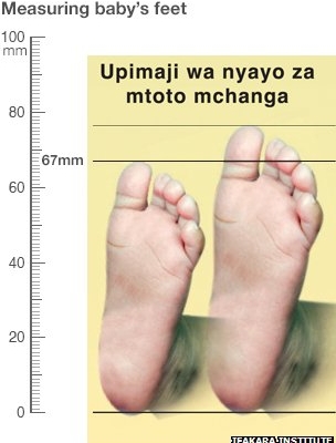 Phương pháp đo bàn chân có thể cứu mạng sống trẻ em