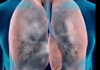 Hút thuốc lá – Cảnh báo chứng bệnh COPD nguy hiểm