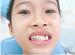 Nguyên nhân và cách điều trị cắn chéo răng trước ở trẻ hiệu quả