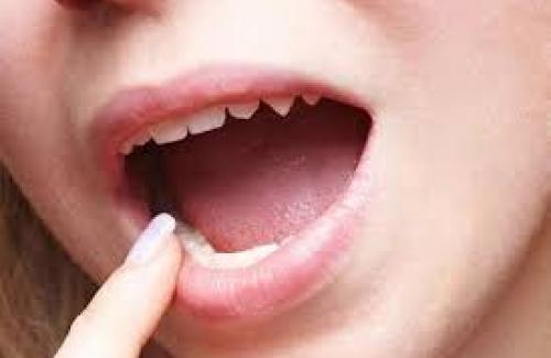 Sùi mào gà miệng - Triệu chứng, nguyên nhân và biến chứng của bệnh