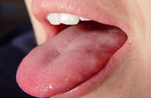 Sùi mào gà ở lưỡi giai đoạn đầu - nguyên nhân và cách phòng tránh
