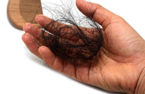 Triệu chứng rụng tóc nhiều cần phân biệt đâu là sinh lý đâu là bệnh lý