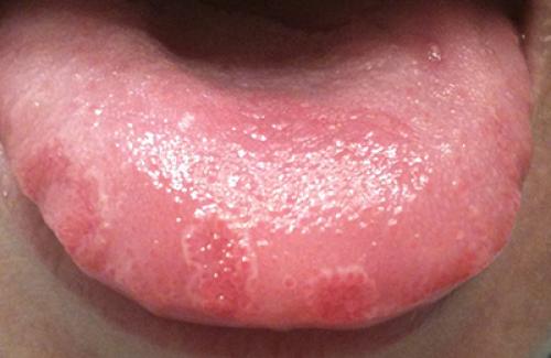 Triệu chứng sùi mào gà ở miệng và các biến chứng nguy hiểm của bệnh