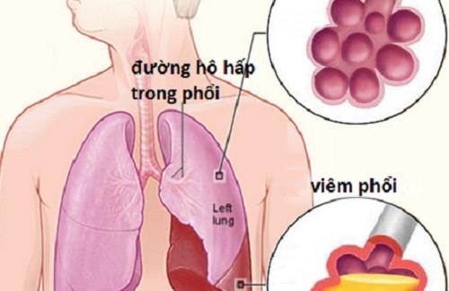 Tăng nguy cơ ung thư đường hô hấp khi nhiễm độc khói nhang
