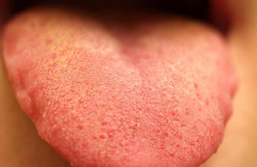 Dấu hiệu sùi mào gà ở lưỡi và những nguyên nhân gây bệnh