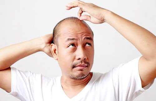 Nguyên nhân rụng tóc ở nam giới thường gặp hiện nay