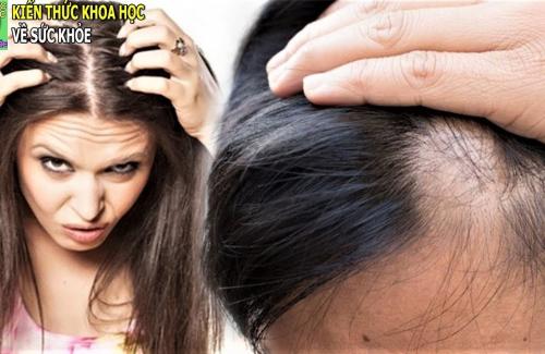 Rụng tóc dấu hiệu của bệnh gì, nguy hại đến sức khỏe thế nào?
