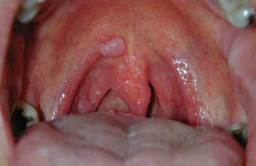 Triệu chứng của sùi mào gà ở miệng và cách làm giảm triệu chứng bệnh