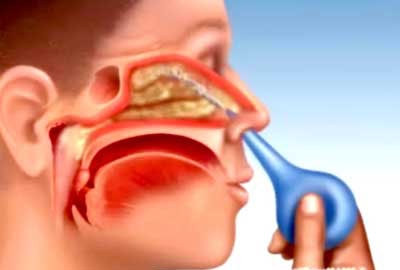 Lạm dụng thuốc xịt mũi, đề phòng chứng bệnh tăng huyết áp