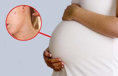 Các biện pháp ngăn chặn để không mắc bệnh Rubella khi mang thai