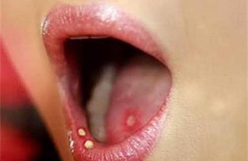 Bệnh giang mai ở miệng và những biến chứng nguy hiểm của bệnh