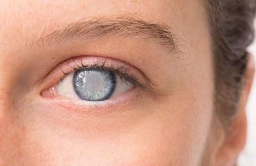 Nguyên nhân khiến đục thủy tinh thể gây mù cả hai mắt
