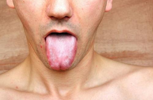 Triệu chứng giang mai ở miệng và cách phòng tránh bệnh