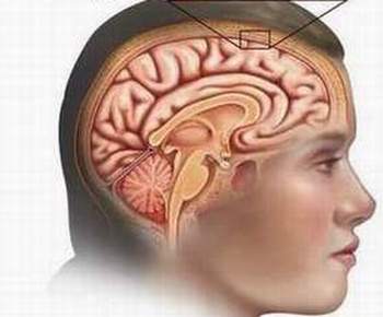 Cách nhận biết trệu chứng báo trước bệnh xuất huyết não