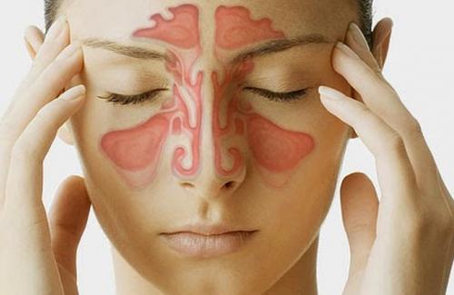 “Ngọc bình phong tán” – Điều trị bệnh viêm mũi dị ứng hiệu quả