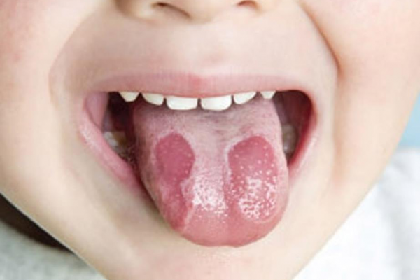 Nguyên nhân và phương pháp điều trị bệnh loét lưỡi
