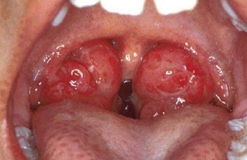 Triệu chứng sùi mào gà ở họng và các biện pháp phòng bệnh