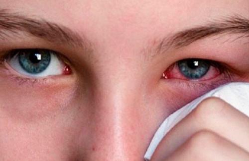 Chứng xuất huyết mắt, nguyên nhân và biểu hiện của căn bệnh như thế nào?