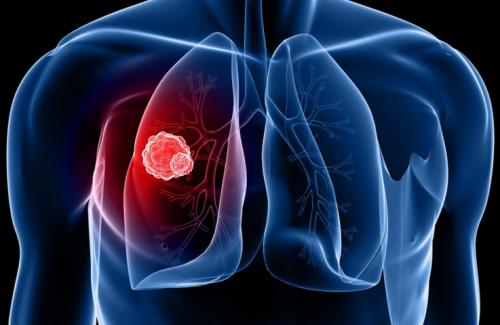 Những điều bạn cần biết về khối u lành tính xuất hiện ở phổi