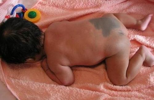 Lý giải về vết bớt xanh thường thấy trên mông trẻ sơ sinh