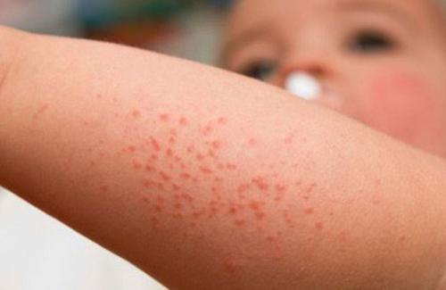 Nhiễm siêu vi có thể gây bệnh sốt xuất huyết ở trẻ