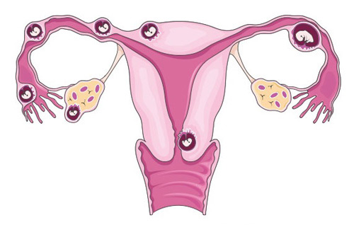 Những biến chứng nguy hiểm mẹ bầu thường gặp trong các giai đoạn thai kỳ