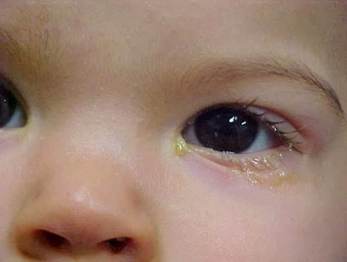 Cảnh báo: 3 dấu hiệu nguy hiểm đối với mắt của bé các mẹ cần biết