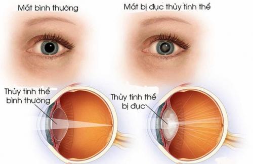 Nguyên nhân dẫn đến đục nhân mắt ở trẻ nhỏ cần biết