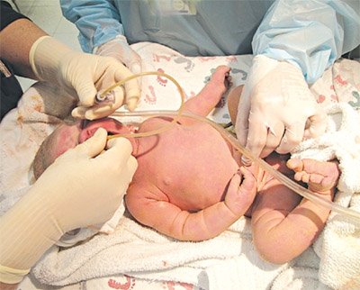 Nguyên nhân của hội chứng hít ối phân su ở trẻ sơ sinh