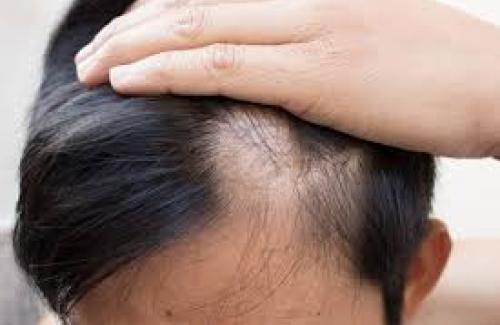 Triệu chứng rụng tóc ở nam giới đặc trưng hàng đầu