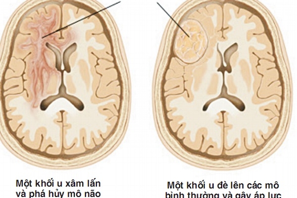 Làm sao để pháp hiện mắc chứng bệnh u não sớm nhất?