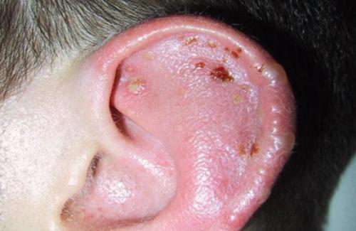 Nguyên nhân và cách điều trị chàm vành tai ở trẻ sơ sinh dứt điểm