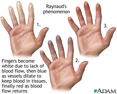 Hội chứng Raynaud trong xơ cứng bì gây tổn thương mạch máu