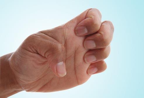 ok:Hội chứng kênh Guyon gây teo cơ bàn tay gây nguy hiểm