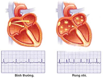 ok:Hội chứng “tan nát con tim” nguyên nhân bắt nguồn từ việc thất tình